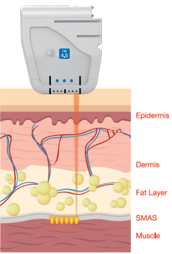 4.5 millimeter facial cartridge transmission depth diagram